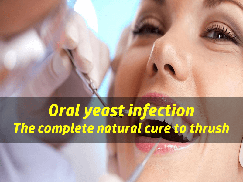 Yeast Infection In Mouth The Natural Treatment To Oral Thrush Mouth 