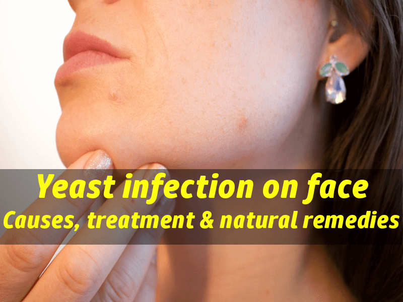 Yeast Infection On Face Causes Treatment Natural Home Remedies