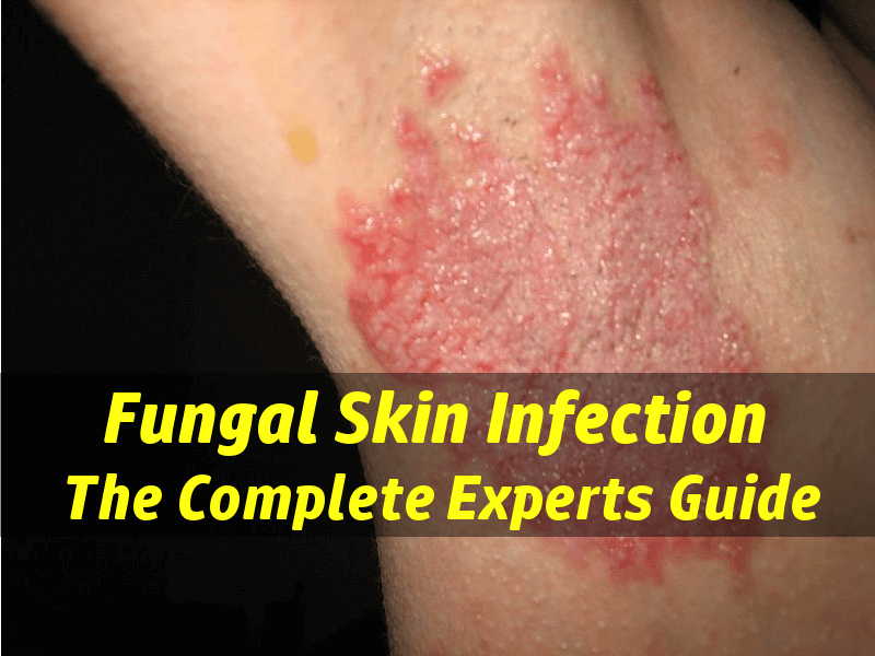 Difference Between Fungal And Bacterial Infection Cau - vrogue.co