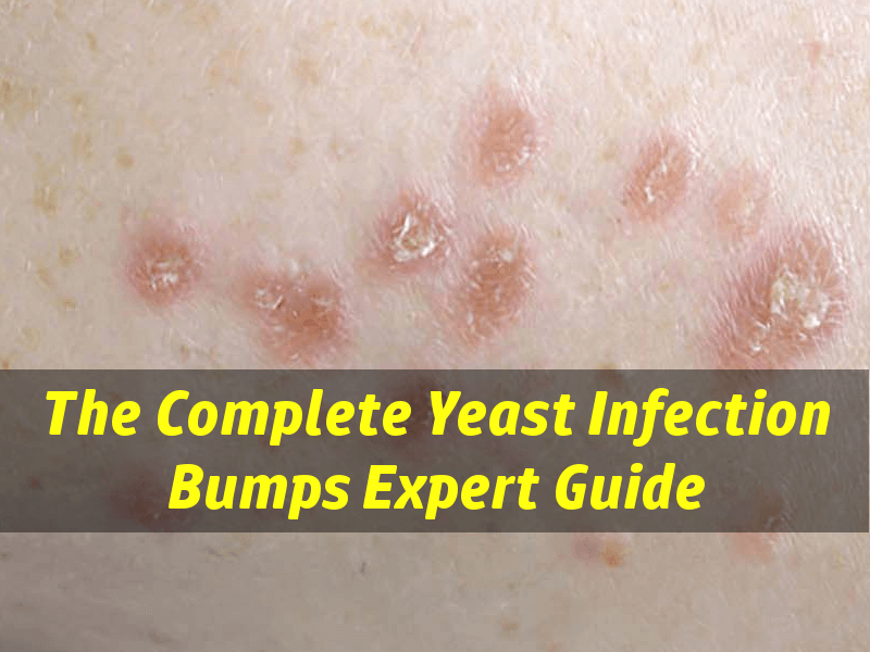 Yeast Infection Bumps - Are Your Skin Bumps Caused By -4421
