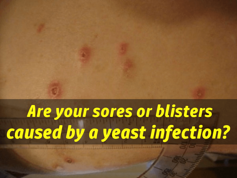 Can A Yeast Infection Cause Sores Around Anus