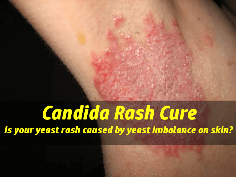 Candida Rashes Is Your Yeast Rash Caused By Yeast Imbalance On Skin 